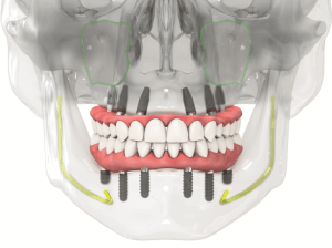 straumann implant