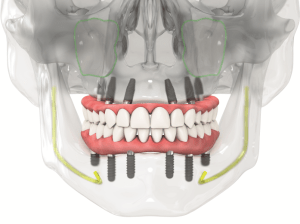straumann implant