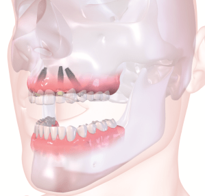 straumann implant