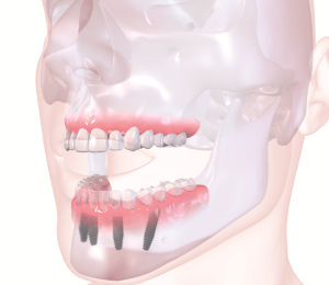 straumann implant