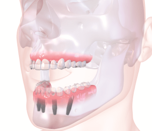 straumann implant